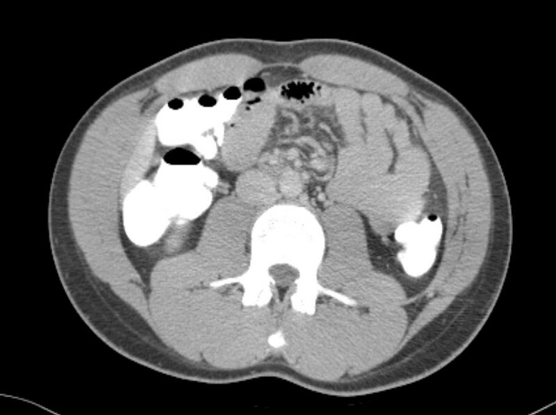 File:Appendicitis and incidental foregut duplication cyst (Radiopaedia 52962-58916 A 31).jpg