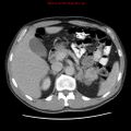 Appendicitis and renal cell carcinoma (Radiopaedia 17063-16760 A 16).jpg