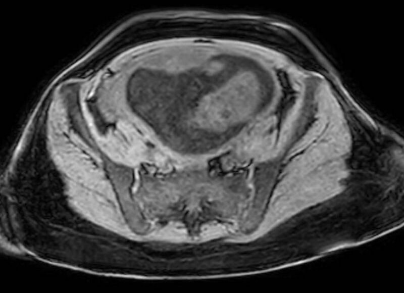 File:Appendicitis in gravida (MRI) (Radiopaedia 89433-106395 Axial DIXON 111).jpg