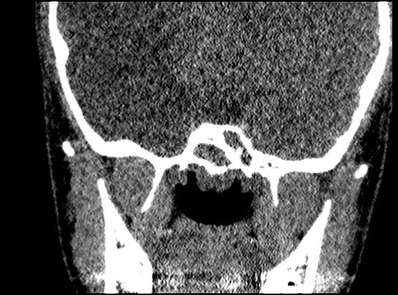 File:Arachnoid cyst- extremely large (Radiopaedia 68741-78450 Coronal bone window 14).jpg