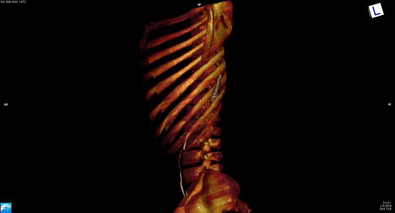 File:Arrow injury to the chest (Radiopaedia 75223-86321 3D bone 12).jpg