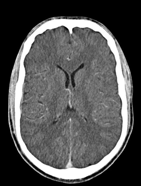 File:Arrow injury to the face (Radiopaedia 73267-84011 Axial C+ delayed 57).jpg