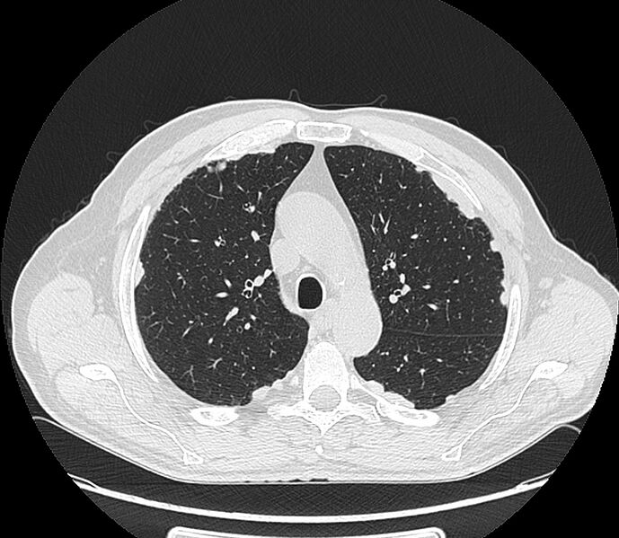 File:Asbestos pleural placques (Radiopaedia 57905-64872 Axial lung window 84).jpg