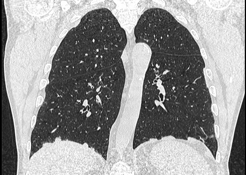 File:Asbestos pleural placques (Radiopaedia 57905-64872 Coronal lung window 189).jpg