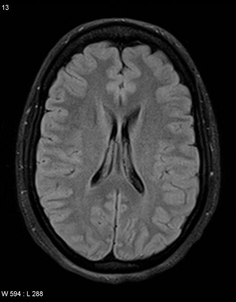 File:Astroblastoma (Radiopaedia 39792-42217 Axial FLAIR 12).jpg