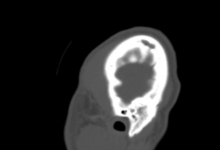 Asymptomatic occipital spur (Radiopaedia 87753-104201 Sagittal bone window 301).jpg
