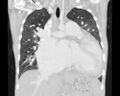 Atrial septal defect complicated by Eisenmenger syndrome (Radiopaedia 53707-59768 Sagittal lung window 12).jpg