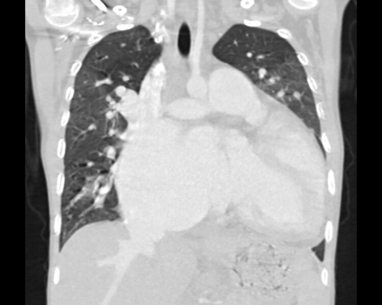 File:Atrial septal defect complicated by Eisenmenger syndrome (Radiopaedia 53707-59768 Sagittal lung window 12).jpg