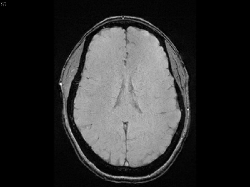 Atypical meningioma - intraosseous (Radiopaedia 64915-74572 Axial SWI 53).jpg