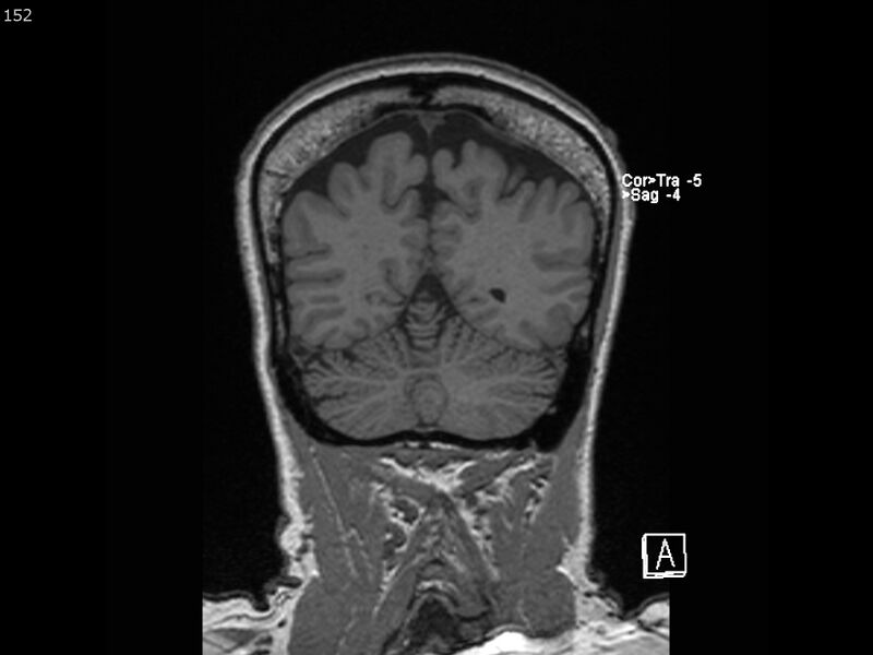 File:Atypical meningioma - intraosseous (Radiopaedia 64915-74572 Coronal T1 152).jpg