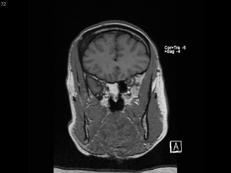 File:Atypical meningioma - intraosseous (Radiopaedia 64915-74572 Coronal T1 72).jpg