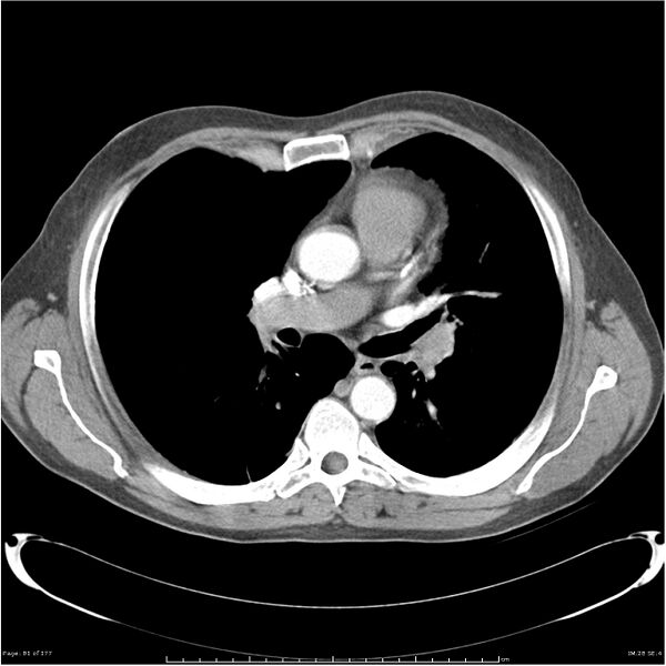 File:Atypical pneumonia - Q fever (Radiopaedia 21993-21989 C+ arterial phase 23).jpg