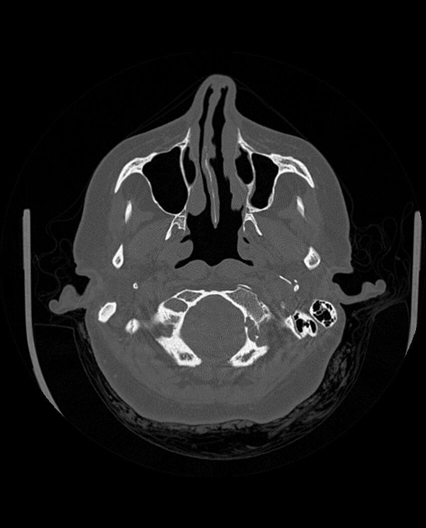 Automastoidectomy with labyrinthine fistula (Radiopaedia 84143-99411 Axial non-contrast 57).jpg