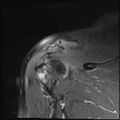 Avulsion fracture - greater tuberosity of humerus (Radiopaedia 71216-81515 Coronal PD fat sat 8).jpg