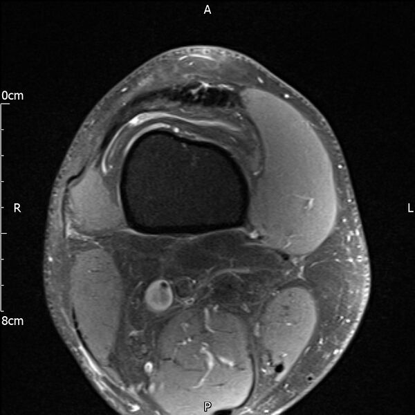 File:Avulsion fracture of the fibular head (Radiopaedia 74804-85808 Axial PD fat sat 1).jpg
