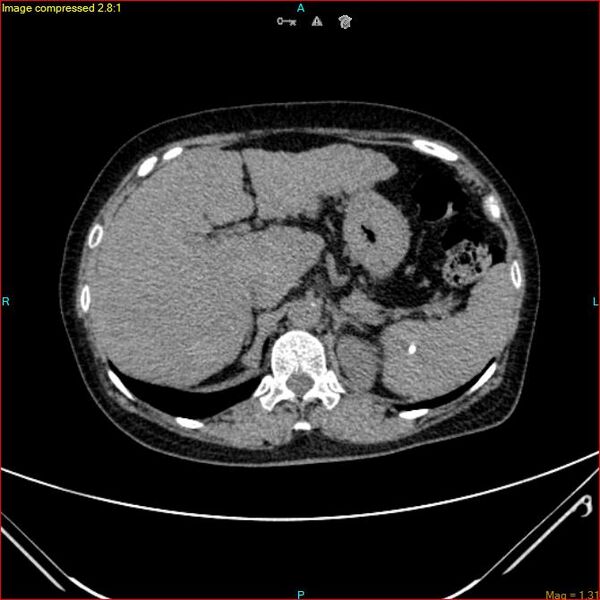 File:Azygos vein aneurysm (Radiopaedia 77824-90130 A 53).jpg