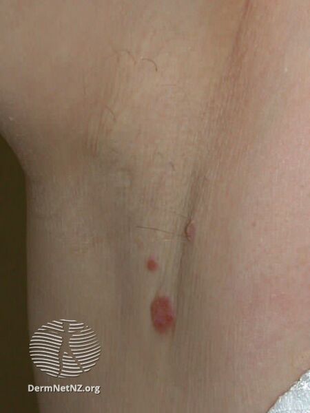 File:Basal cell carcinoma affecting the trunk (DermNet NZ lesions-bcc-trunk-0891).jpg