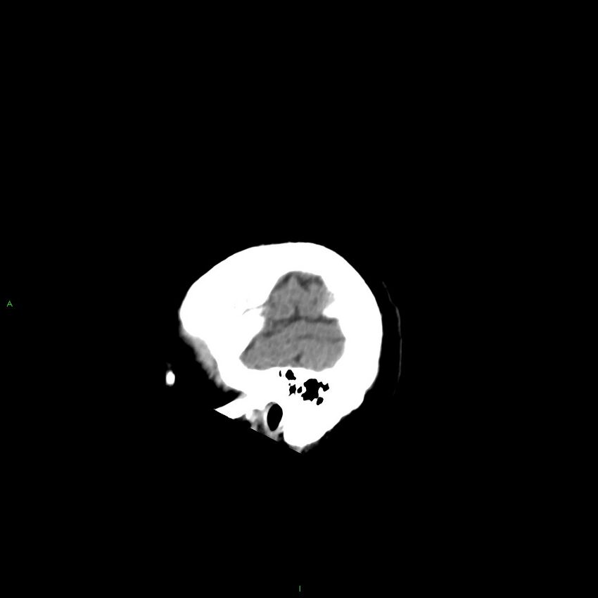 Basal ganglia hemorrhage (Radiopaedia 58346-65467 B 50).jpg