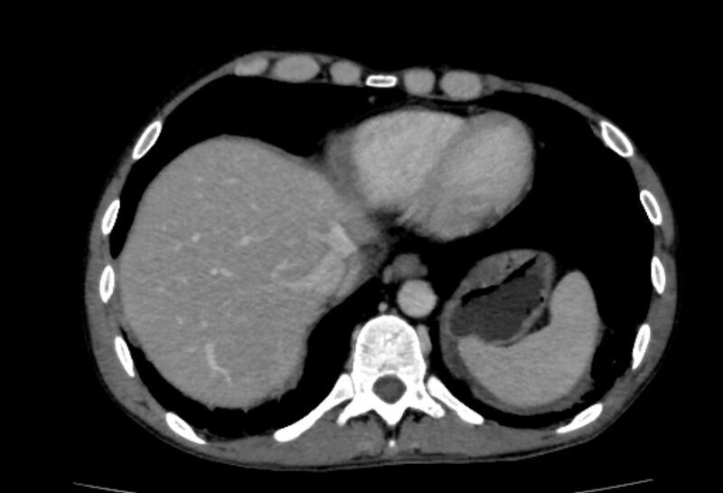 File:Behçet's disease- abdominal vasculitis (Radiopaedia 55955-62570 A 3).jpg