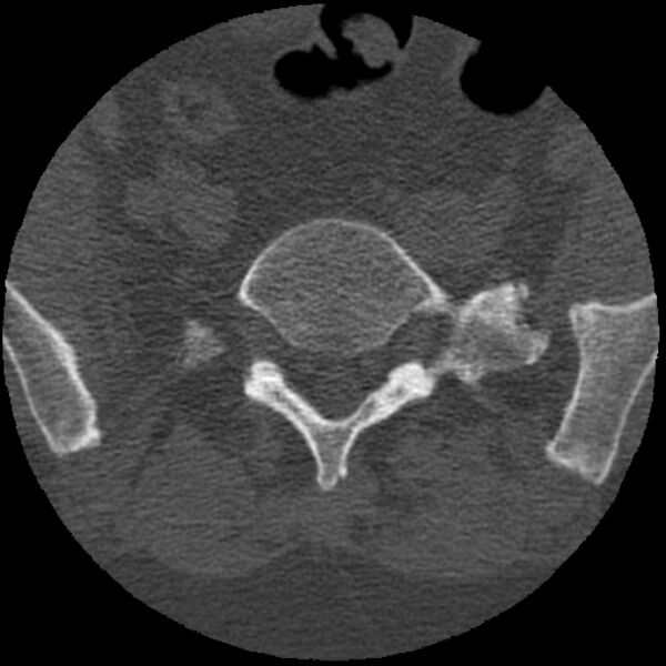 File:Bertolotti syndrome (Radiopaedia 24864-25128 Axial bone window 18).jpg