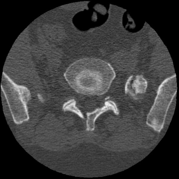 File:Bertolotti syndrome (Radiopaedia 24864-25128 Axial bone window 23).jpg