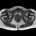 Bicornuate uterus (Radiopaedia 61974-70046 Axial T1 38).jpg