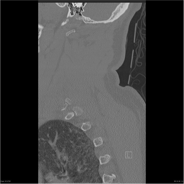 File:Bilateral cervical ribs (Radiopaedia 25868-26017 Sagittal bone window 63).jpg
