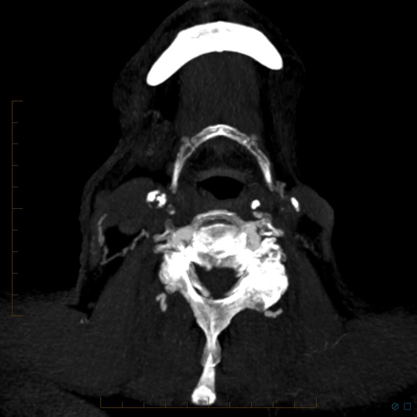 Bilateral chronic common carotid occlusion (Radiopaedia 50849-56362 D 41).jpg