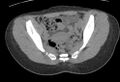 Bilateral mature cystic ovarian teratoma (Radiopaedia 88821-105592 Axial non-contrast 12).jpg
