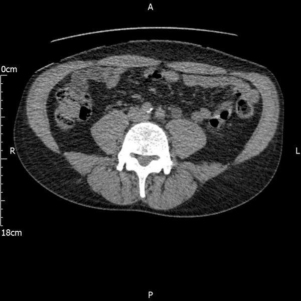 File:Bilateral medullary nephrocalcinosis with ureteric calculi (Radiopaedia 71269-81569 Axial non-contrast 77).jpg