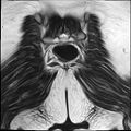 Bilateral ovarian endometriomas (Radiopaedia 87085-103347 Coronal T2 23).jpg