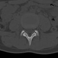Bilateral pars defect (Radiopaedia 26691-26846 Axial bone window 15).jpg