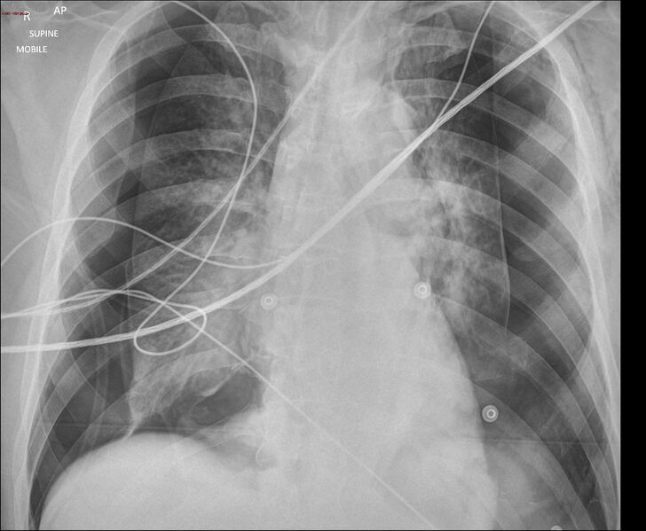 File:Bilateral pneumothoraces with deep sulcus sign (Radiopaedia 73143).jpg