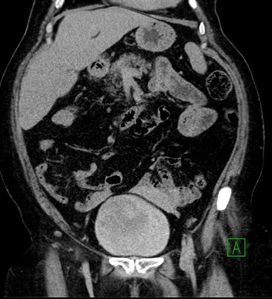 File:Bilateral sporadic synchronous clear cell renal cell carcinoma (Radiopaedia 85035-100575 I 14).jpg