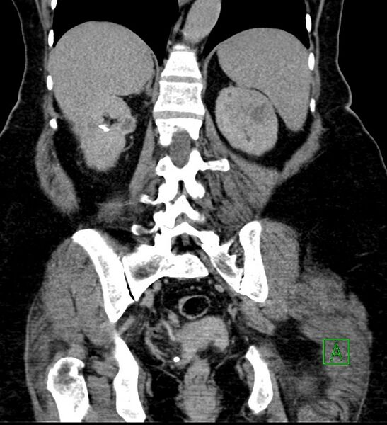 File:Bilateral sporadic synchronous clear cell renal cell carcinoma (Radiopaedia 85035-100575 I 45).jpg