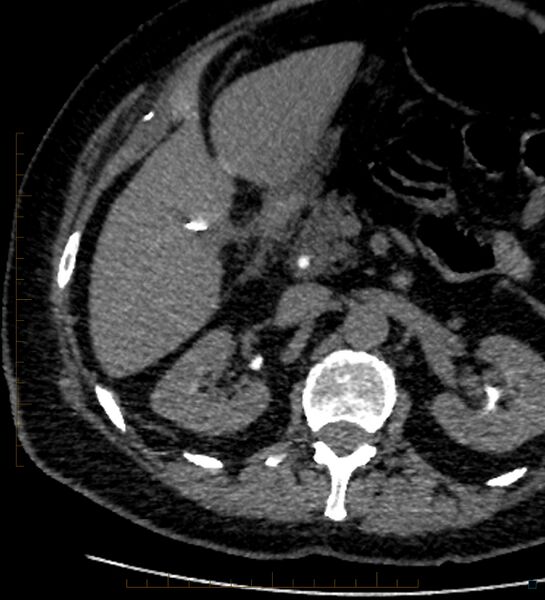 File:Bile leak from accessory duct(s) of Luschka post cholecystectomy (Radiopaedia 40736-43389 A 38).jpg