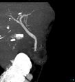Bile leak from accessory duct(s) of Luschka post cholecystectomy (Radiopaedia 40736-43389 D 2).jpg