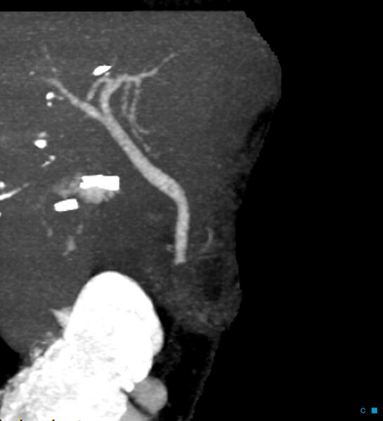 File:Bile leak from accessory duct(s) of Luschka post cholecystectomy (Radiopaedia 40736-43389 D 2).jpg