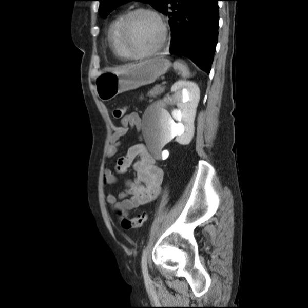 File:Bladder tumor detected on trauma CT (Radiopaedia 51809-57609 E 21).jpg