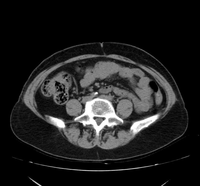 File:Bosniak renal cyst - type IV (Radiopaedia 22929-22953 Axial non-contrast 39).jpg