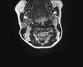 Brachial plexus birth palsy (Radiopaedia 68118-77604 Axial T2 4).jpg