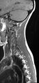 Brachial plexus birth palsy (Radiopaedia 68118-77604 Sagittal T1 11).jpg
