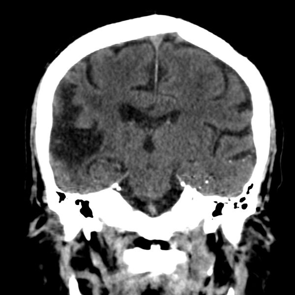 File:Brain Pantopaque remnants (Radiopaedia 78403-91048 Coronal non-contrast 39).jpg