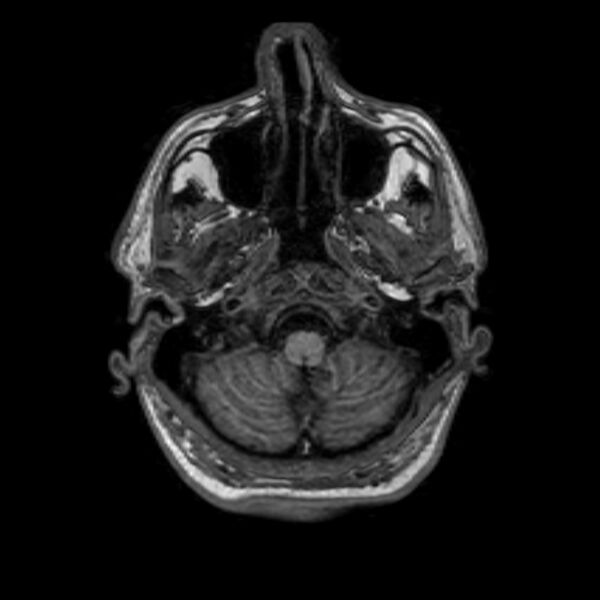 File:Brain abscess complicated by intraventricular rupture and ventriculitis (Radiopaedia 82434-96577 Axial T1 5).jpg