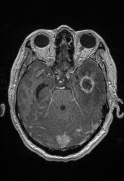 File:Brain abscess with ventriculitis (Radiopaedia 85703-101495 Axial T1 C+ 66).jpg