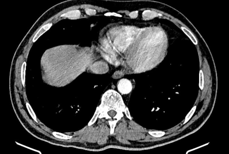 File:Brain metastases - lung cancer primary (Radiopaedia 75060-86116 B 47).jpg