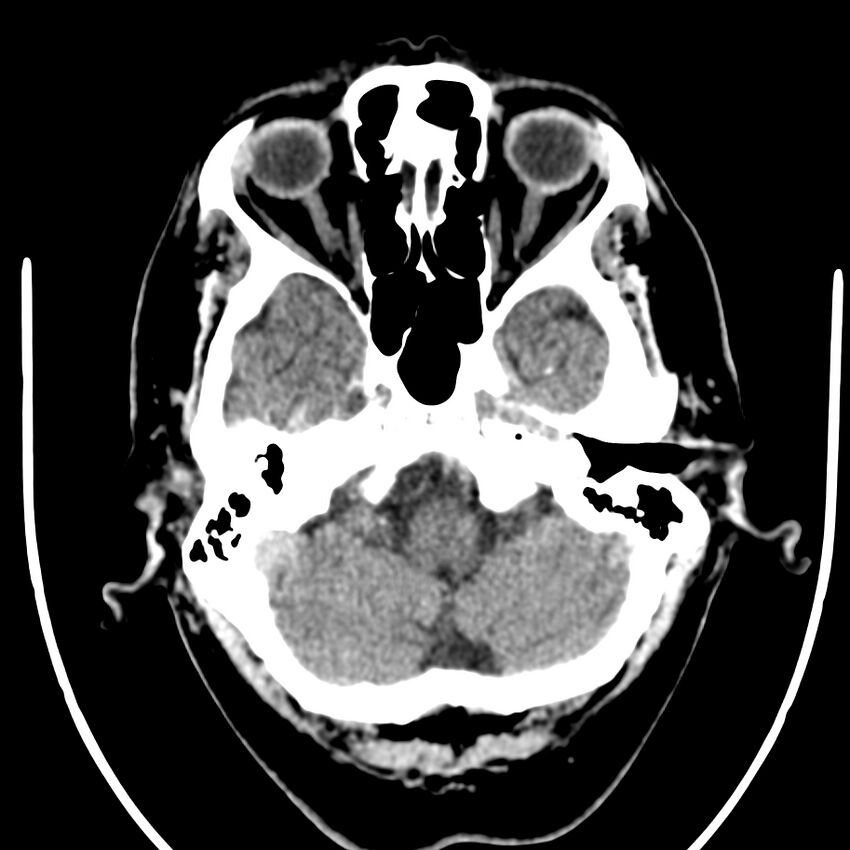 Brain metastasis (Radiopaedia 42617-45760 Axial non-contrast 6).jpg