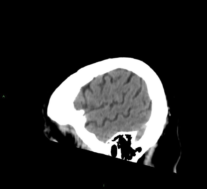 Brainstem hemorrhage (Radiopaedia 58794-66028 C 44).jpg