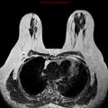 Breast carcinoma (multicentric multifocal in mammary Paget disease) (Radiopaedia 50966-56512 Axial T2 13).jpg