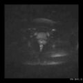 Broad ligament fibroid (Radiopaedia 49135-54241 Axial DWI 24).jpg